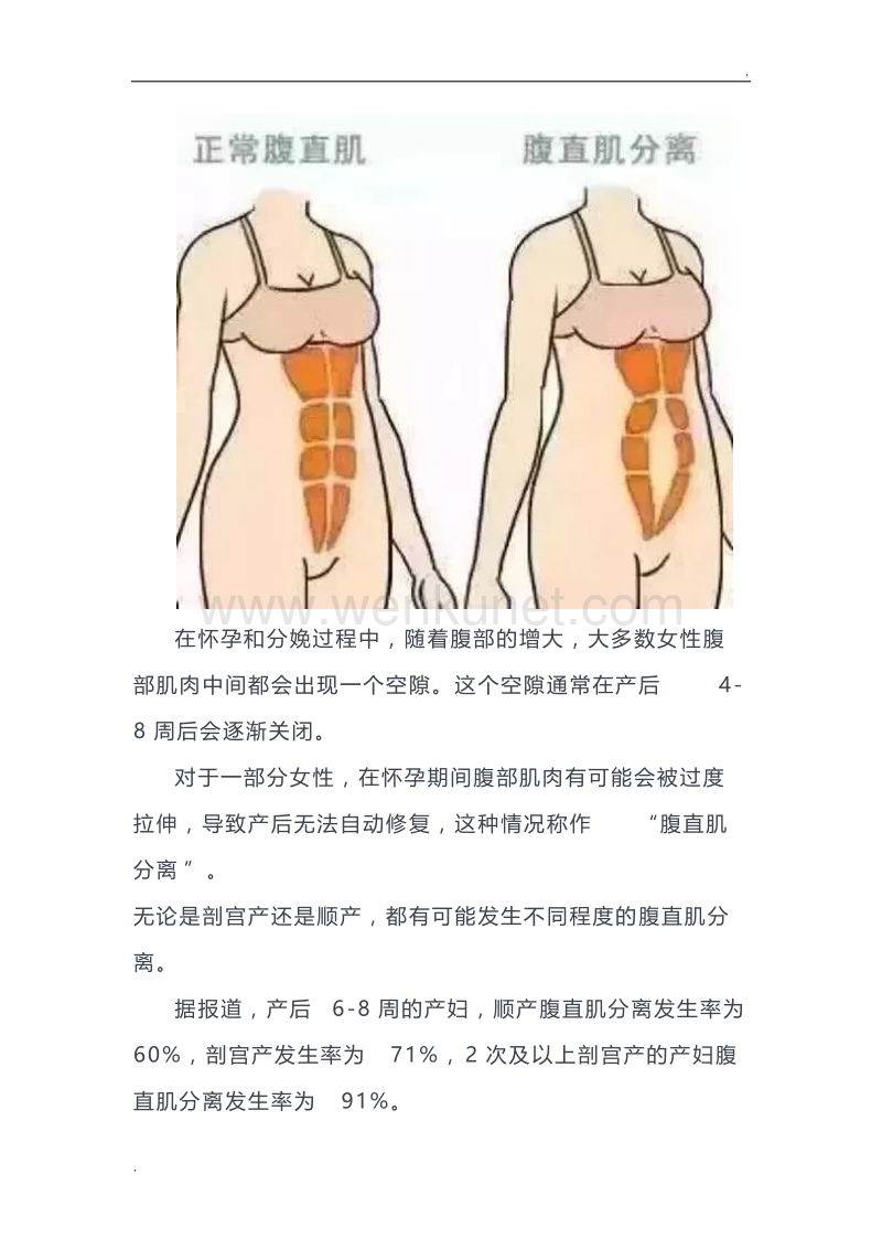 产后康复核心—腹直肌分离与训练方法(有图).docx_第2页