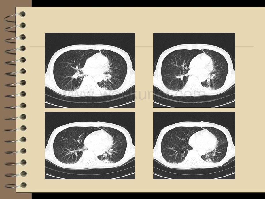 小细胞肺ca_影像诊断.ppt_第3页