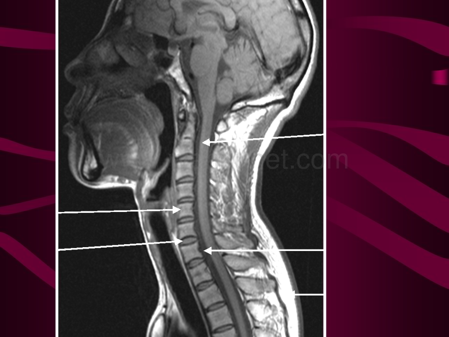 脊髓和椎管内疾病2学时课件.ppt_第3页