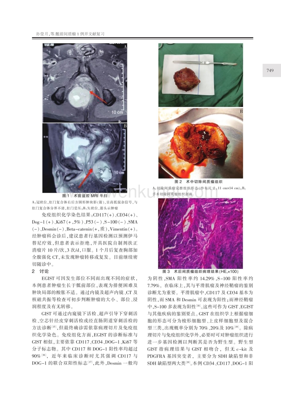 骶前间质瘤1例并文献复习.pdf_第2页