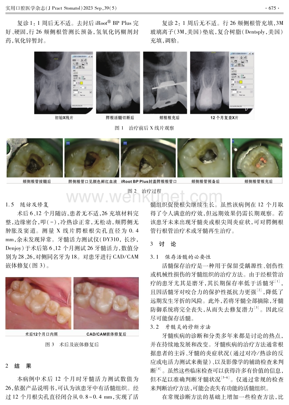 第一恒磨牙活髓切断术 根管治疗术联合治疗1例.pdf_第2页