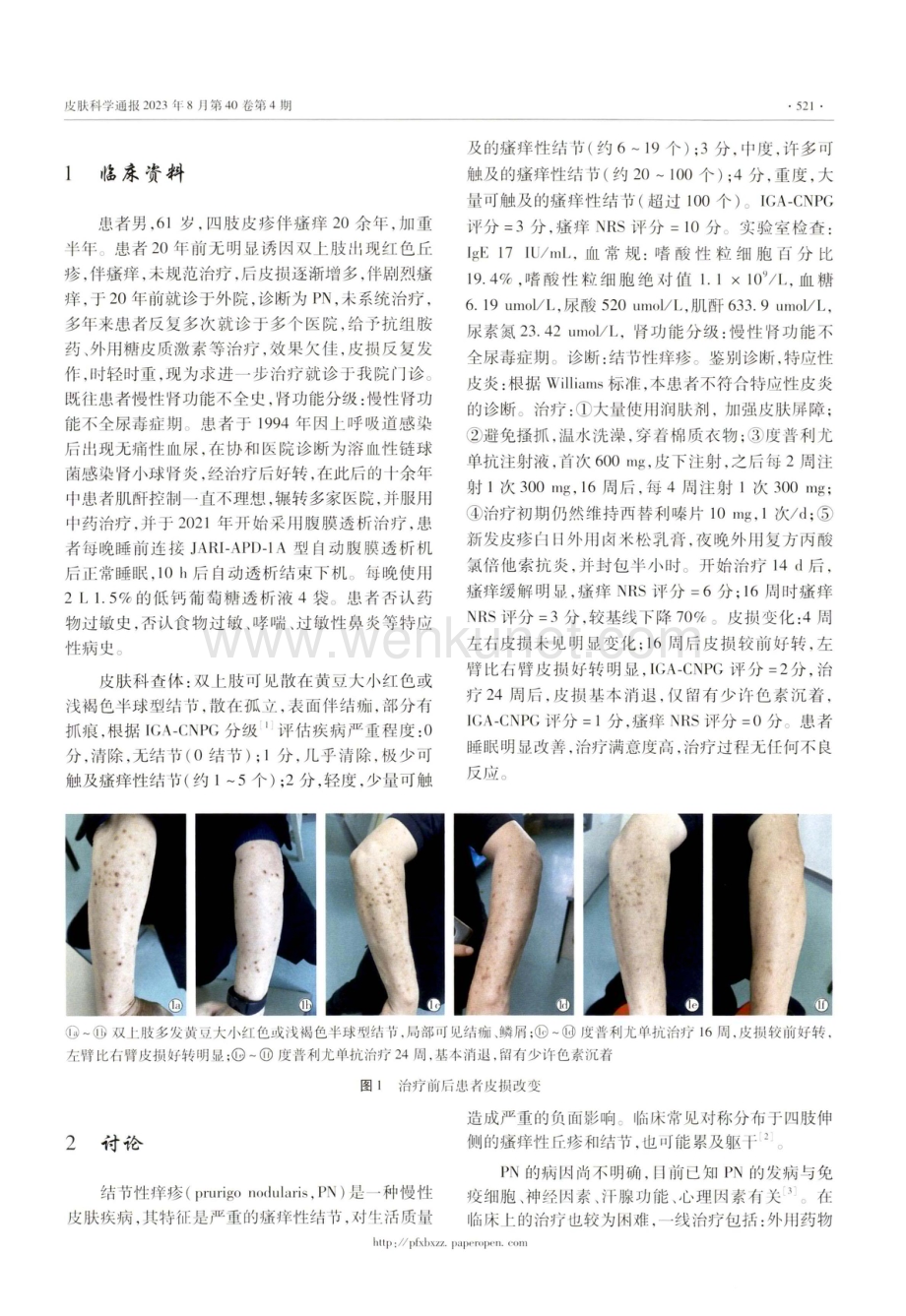 度普利尤单抗治疗结节性痒疹合并维持性腹膜透析1例.pdf_第2页