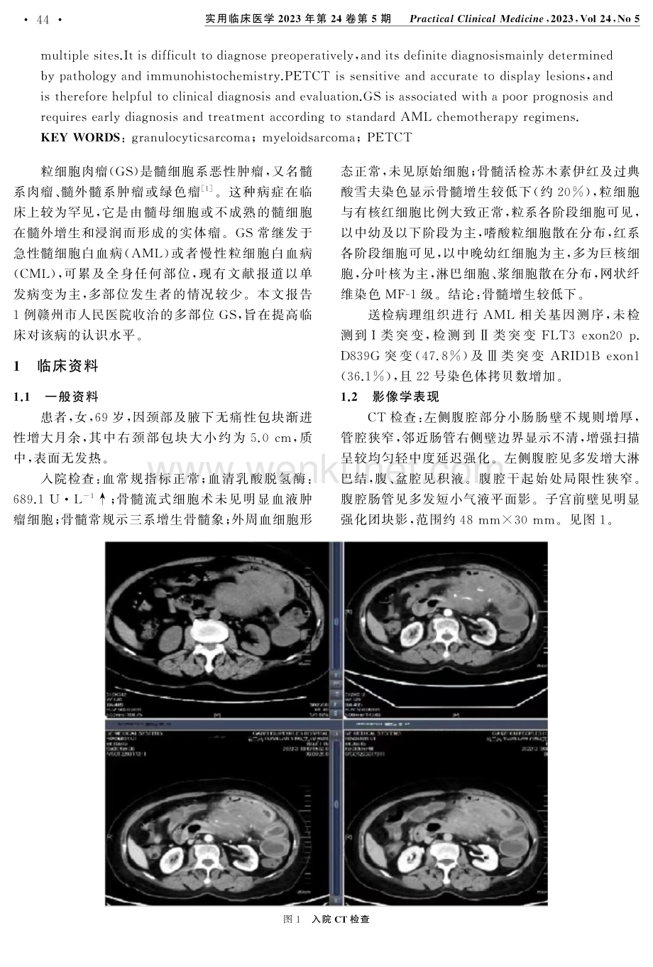 多部位原发性粒细胞肉瘤1例.pdf_第2页