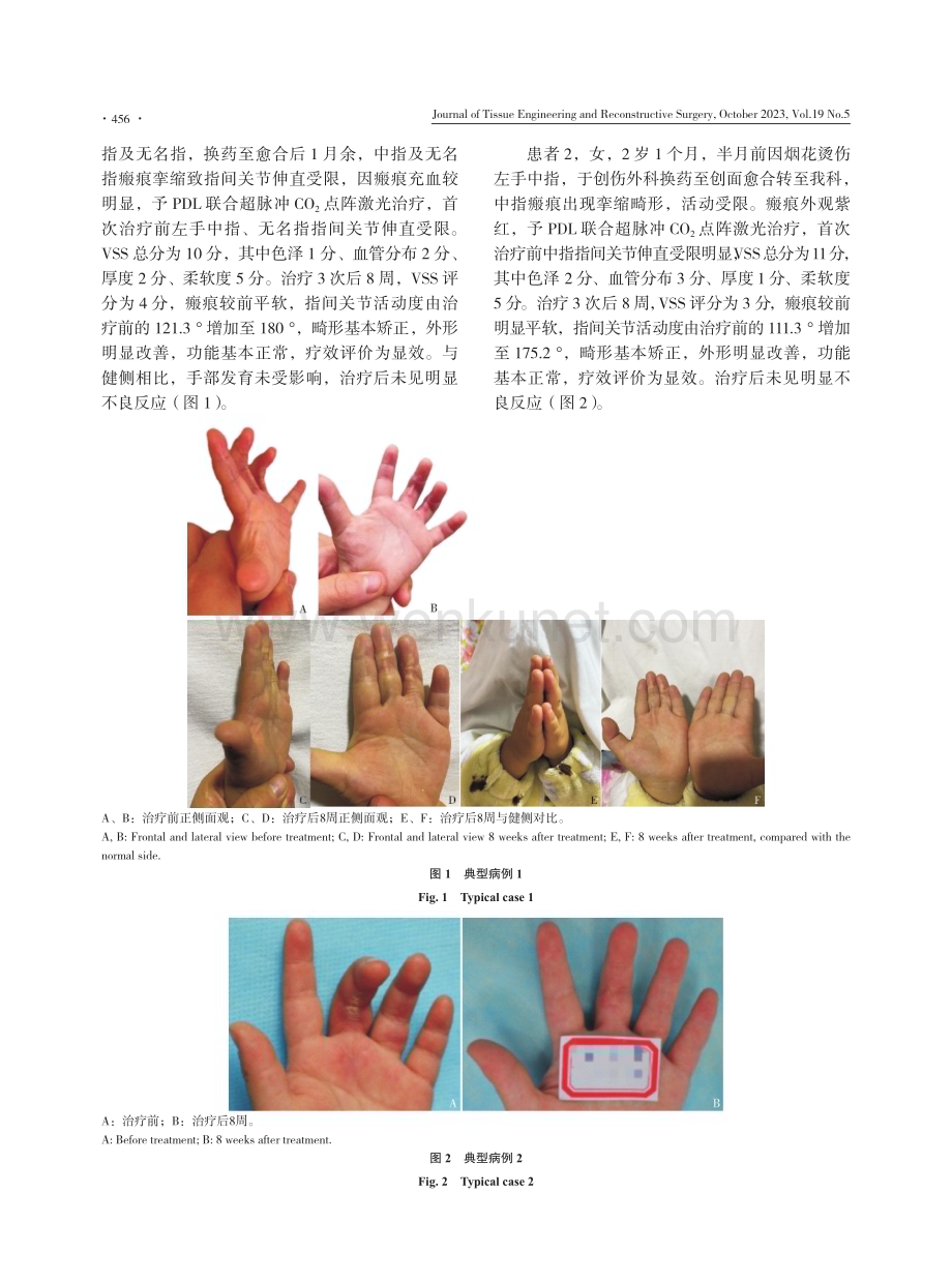 儿童手指挛缩性瘢痕激光治疗体会.pdf_第3页