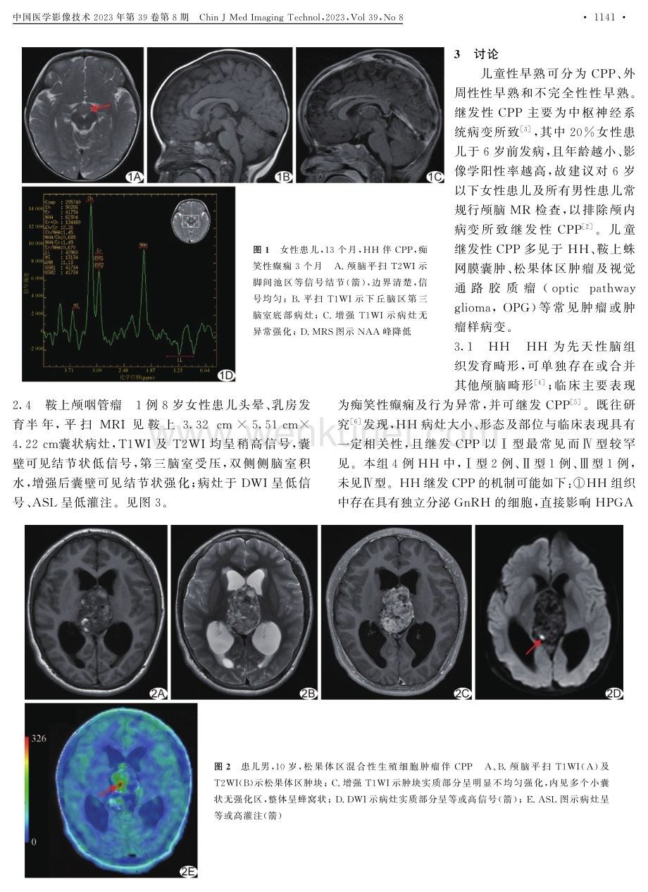 儿童颅内占位伴中枢性性早熟MRI表现.pdf_第3页